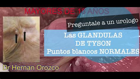 que son glandulas de tyson|Glándulas de Tyson: Factores de Riesgo, Causas, Síntomas,。